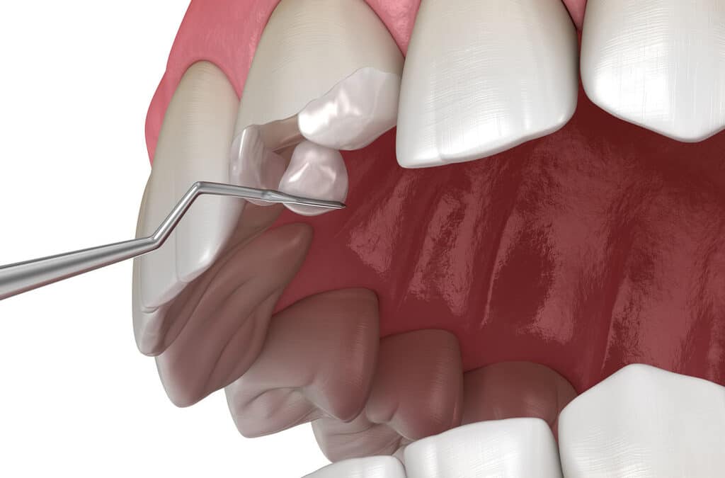 Restauração Dentária - Dente Sim